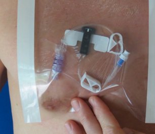 HydroSeal IV Site Barrier Protector, 9 x 9 Inch