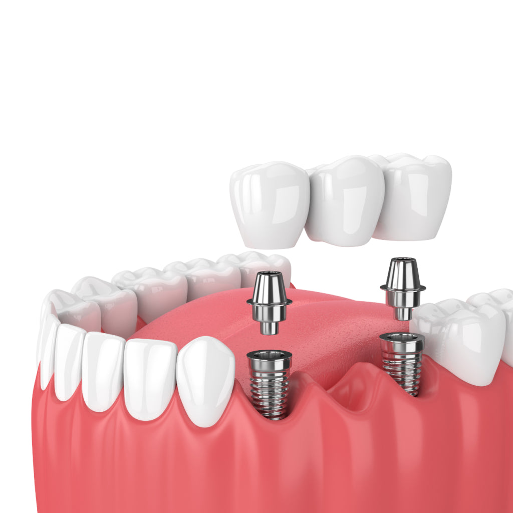 Implants