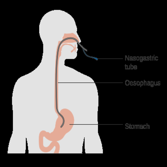 Nasogastric Tube