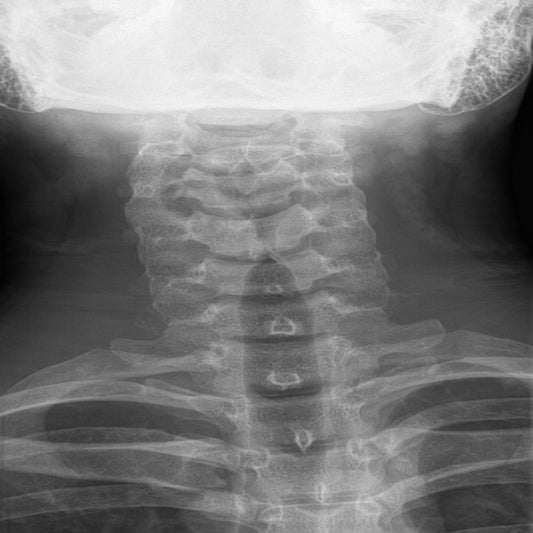 Spinal Rod