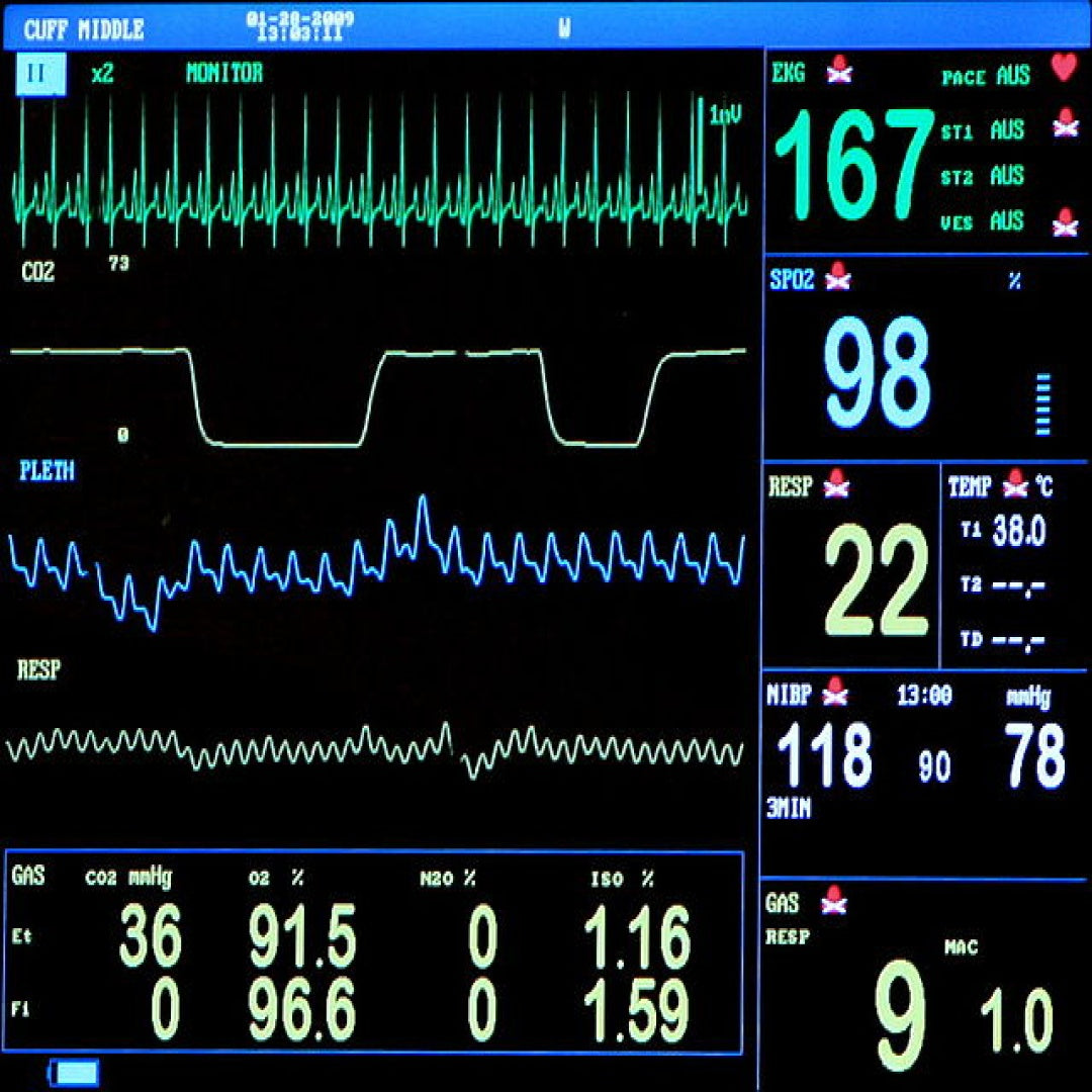 ECG Monitor