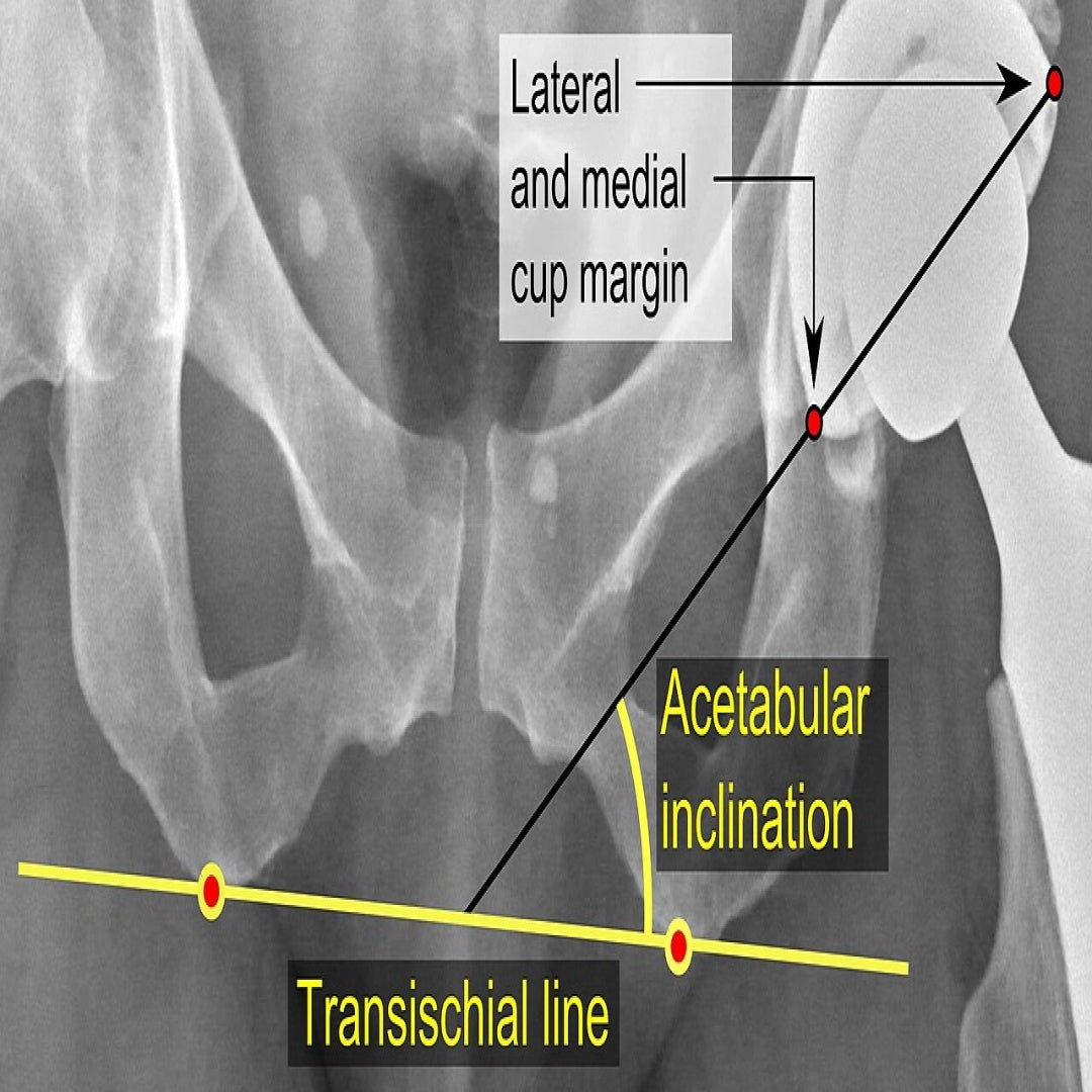 Hip Prosthesis