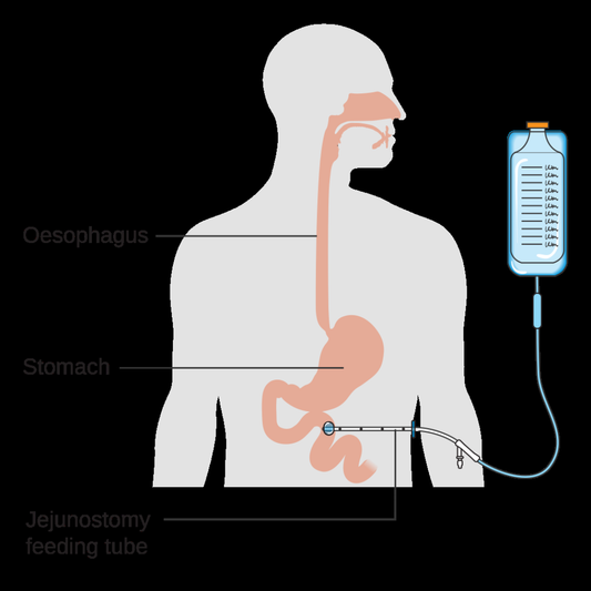 Enteral Feeding Tube