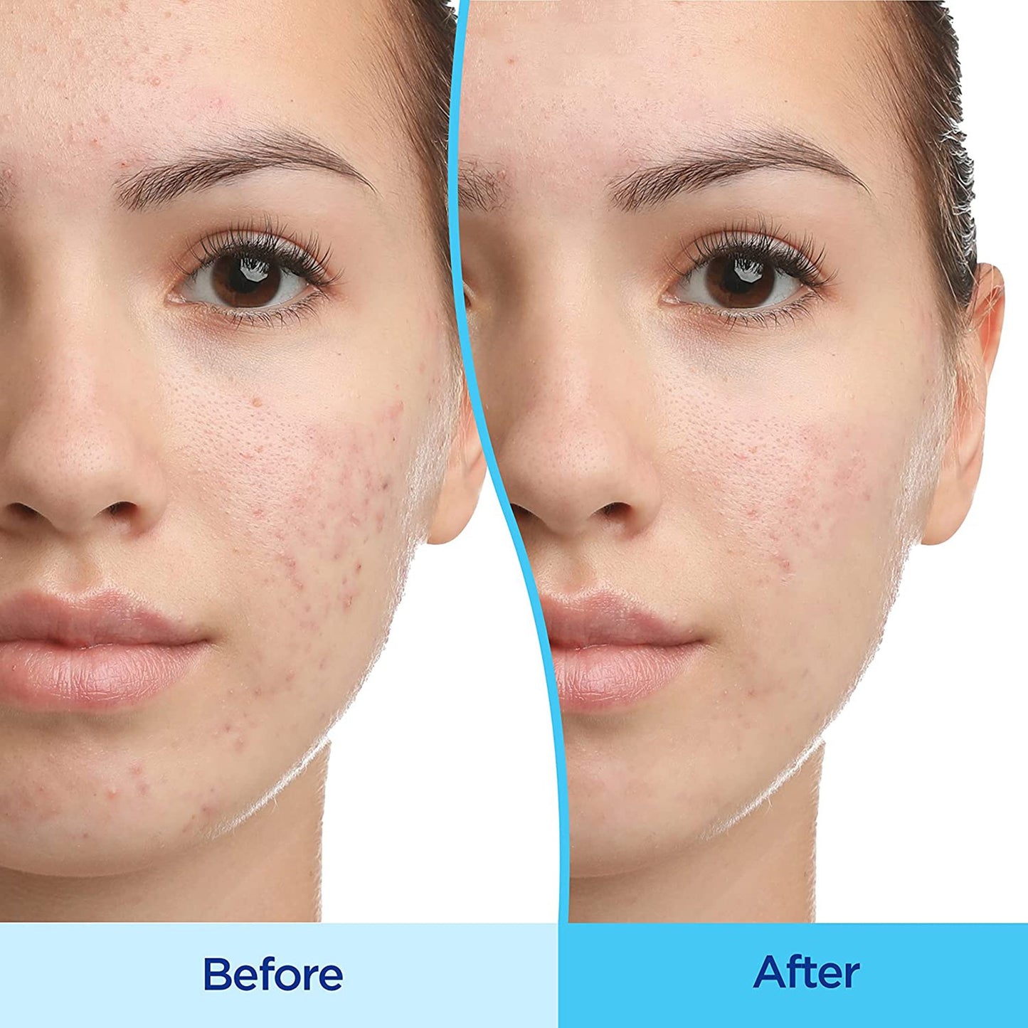 Differin Gel Acne Treatment