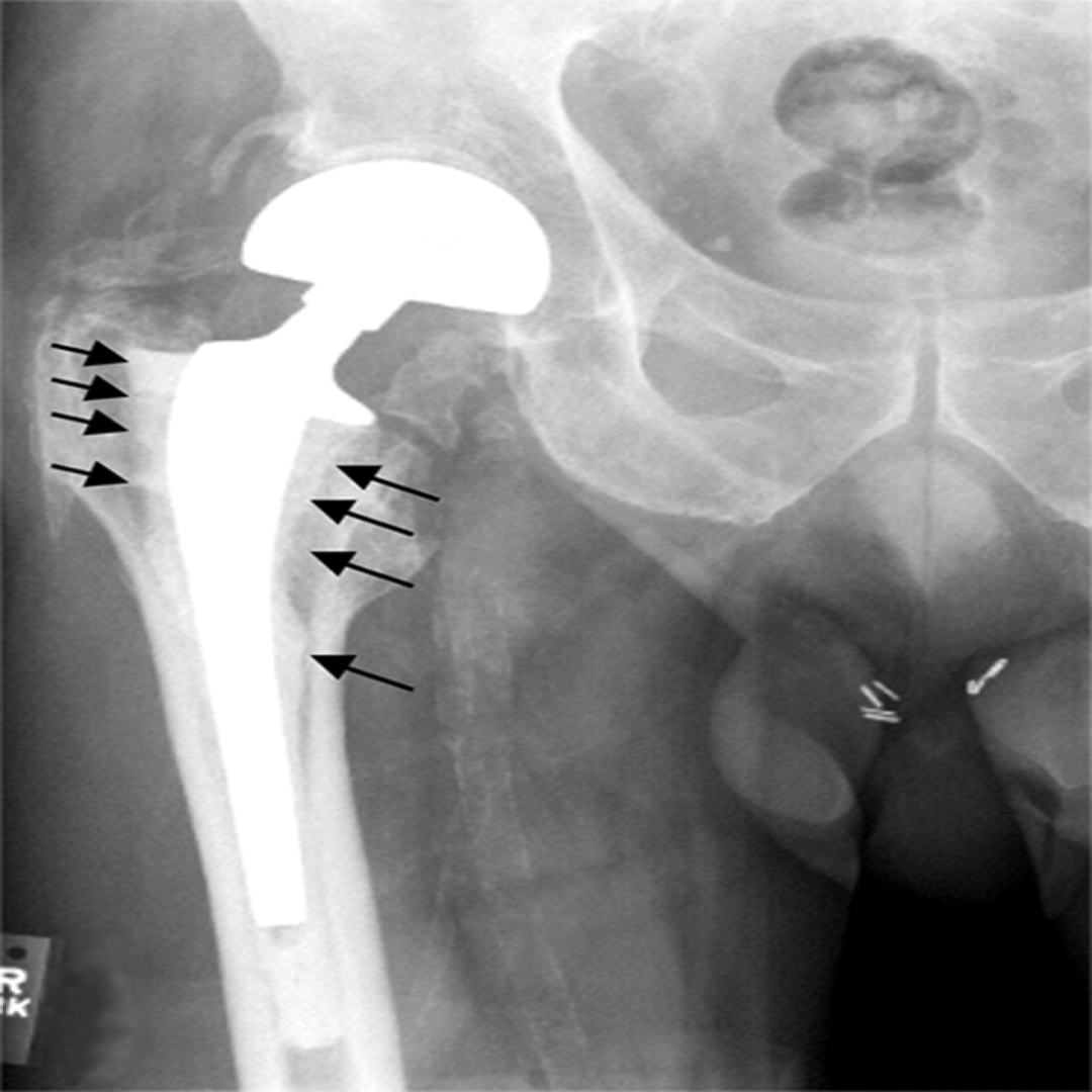 Hip Prosthesis