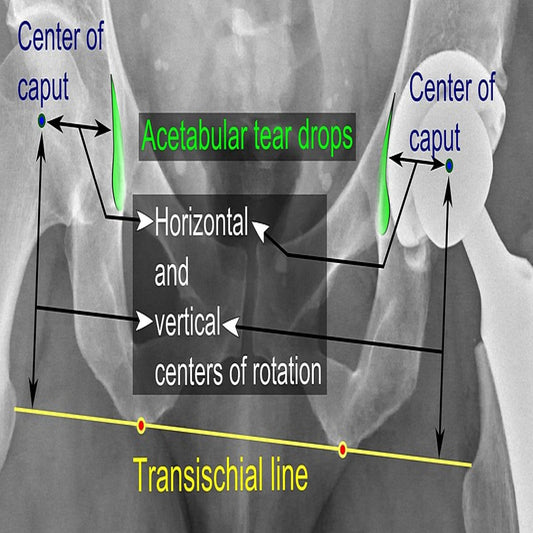 Hip Prosthesis